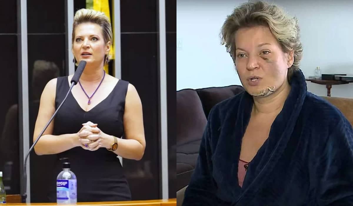 Com várias fraturas, deputada Joice Hasselmann não sabe como foi agredida